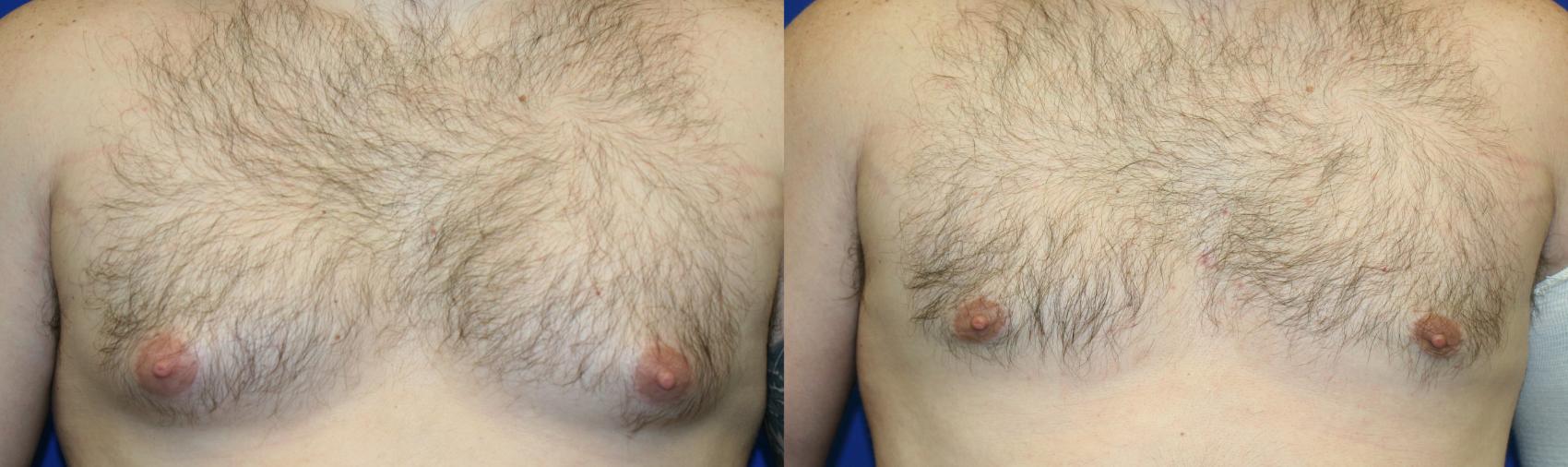 Gynecomastia Case 56 Before & After Front | Downers Grove, IL | Dr. Sandeep Jejurikar