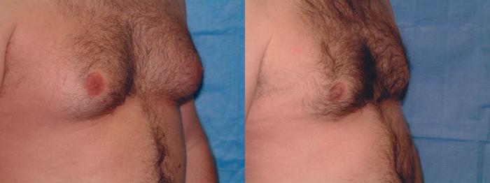 Gynecomastia Case 8 Before & After View #2 | Downers Grove, IL | Dr. Sandeep Jejurikar