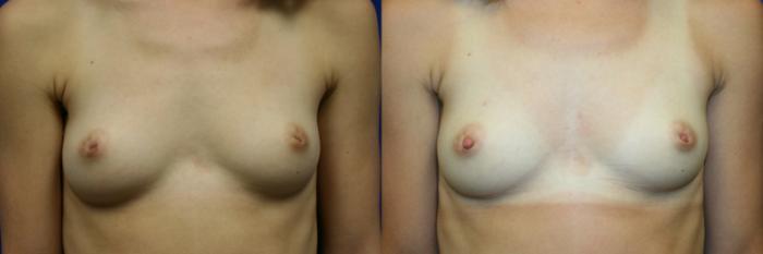 Inverted Nipple Correction Case 59 Before & After Front | Downers Grove, IL | Dr. Sandeep Jejurikar