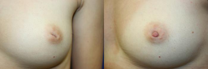 Inverted Nipple Correction Case 59 Before & After Left Side | Downers Grove, IL | Dr. Sandeep Jejurikar