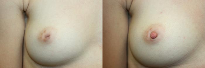 Inverted Nipple Correction Case 59 Before & After Right Side | Downers Grove, IL | Dr. Sandeep Jejurikar