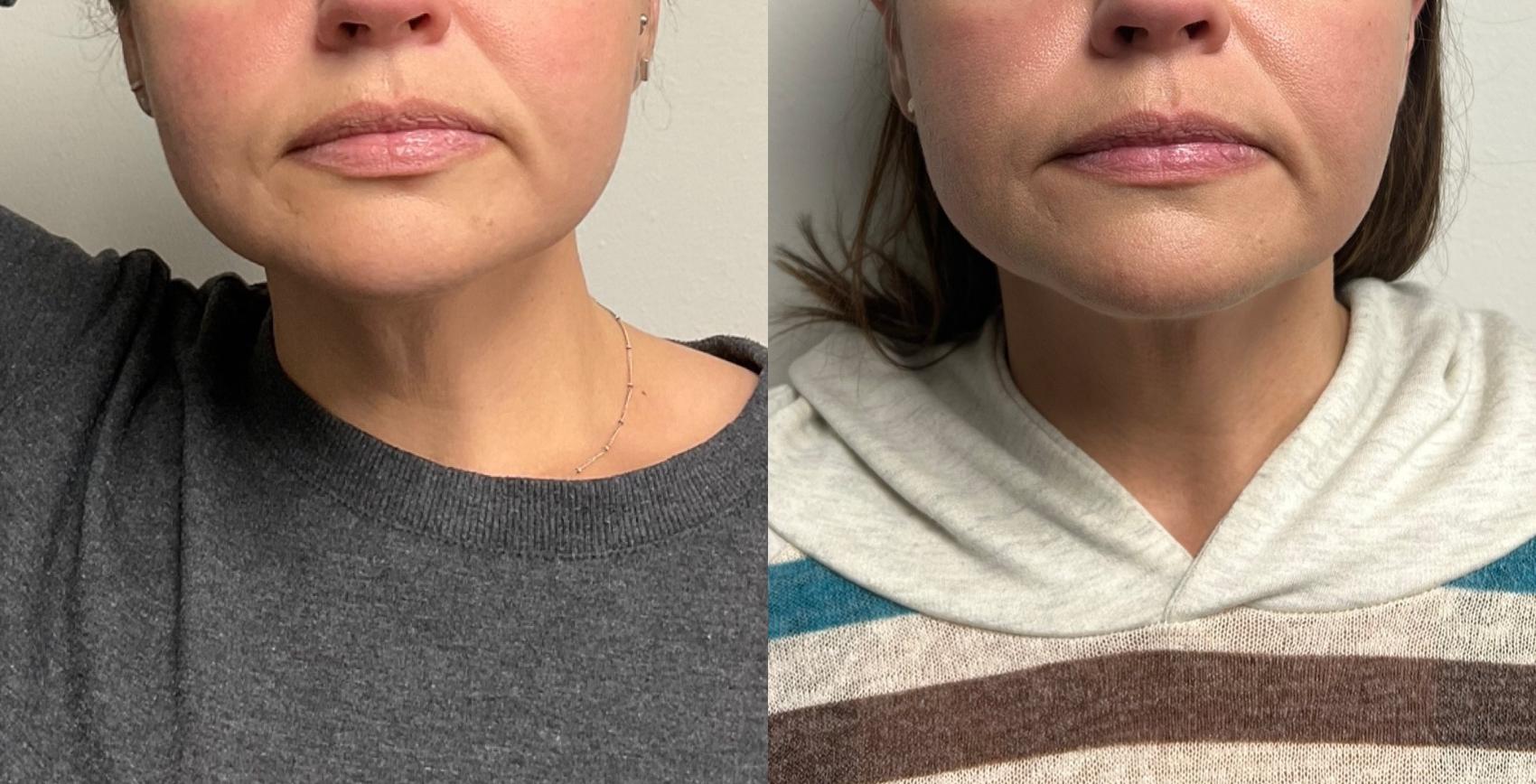 Kybella Case 67 Before & After Front | Downers Grove, IL | Dr. Sandeep Jejurikar