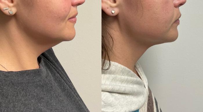 Kybella Case 67 Before & After Right Side | Downers Grove, IL | Dr. Sandeep Jejurikar