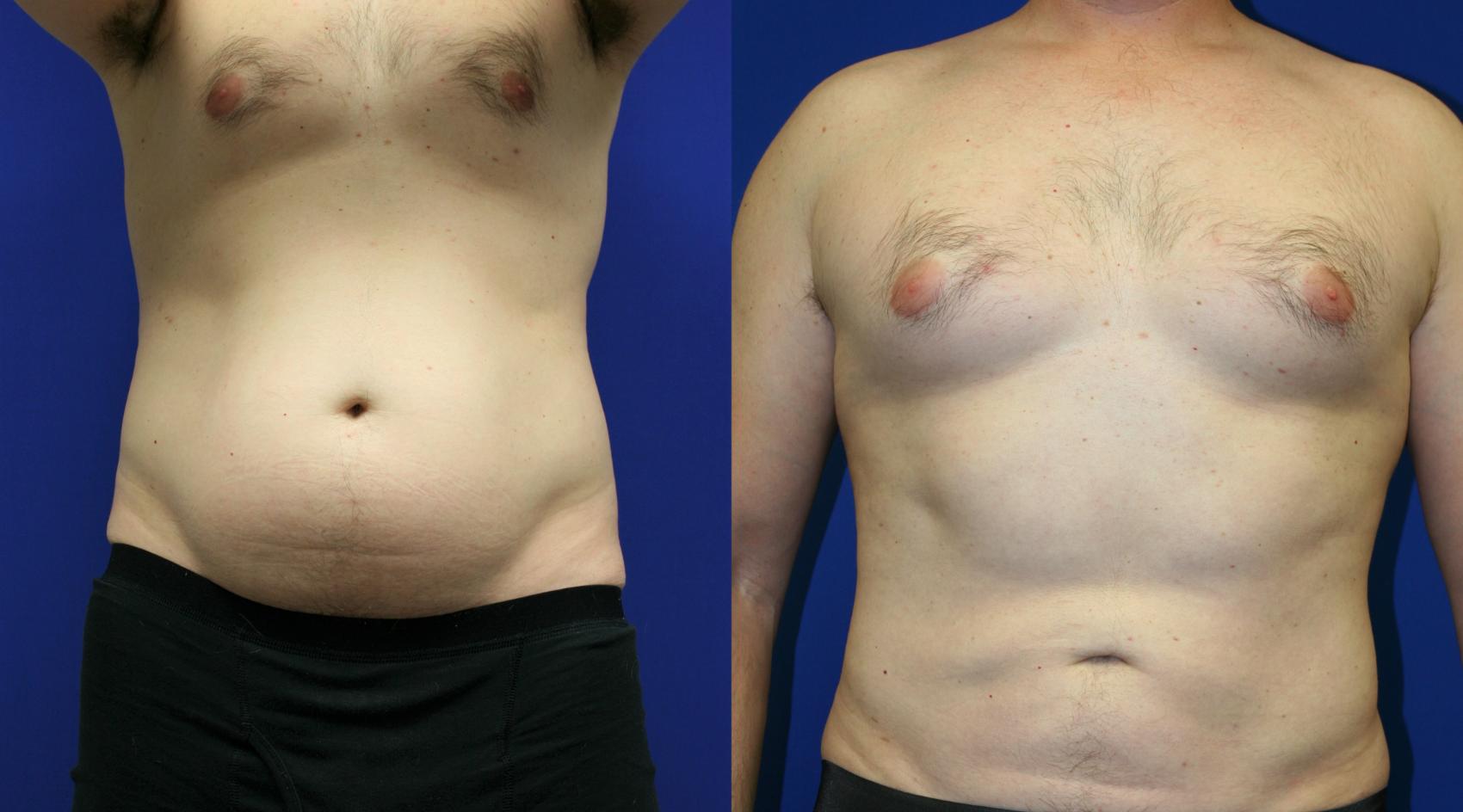 Post Op Surgery Gynecomastia Lipo Slim