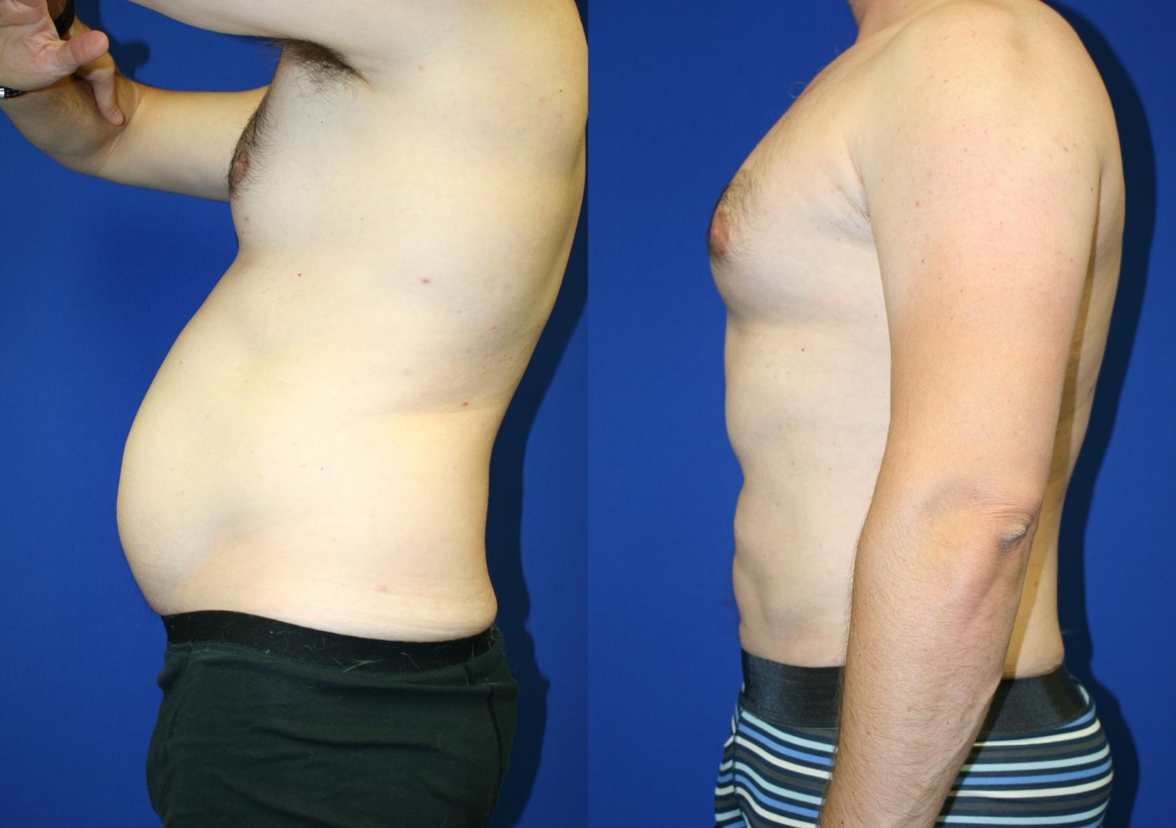 Liposuction Case 53 Before & After Left Side | Downers Grove, IL | Dr. Sandeep Jejurikar
