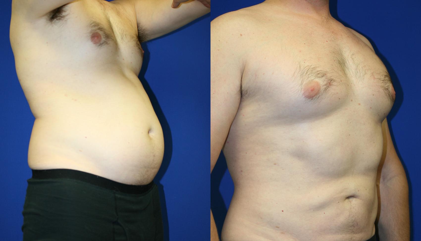 Liposuction Case 53 Before & After Right Oblique | Downers Grove, IL | Dr. Sandeep Jejurikar
