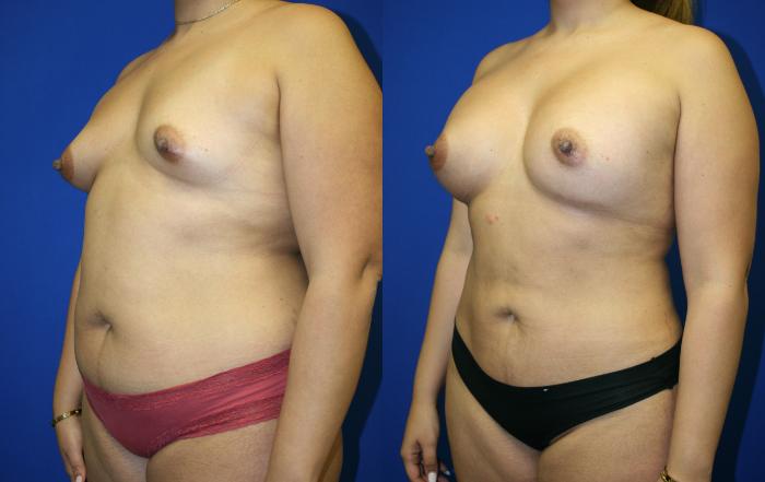 Breast Augmentation Case 66 Before & After Left Oblique | Downers Grove, IL | Dr. Sandeep Jejurikar