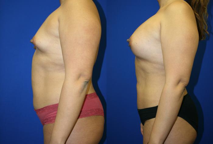 Breast Augmentation Case 66 Before & After Left Side | Downers Grove, IL | Dr. Sandeep Jejurikar