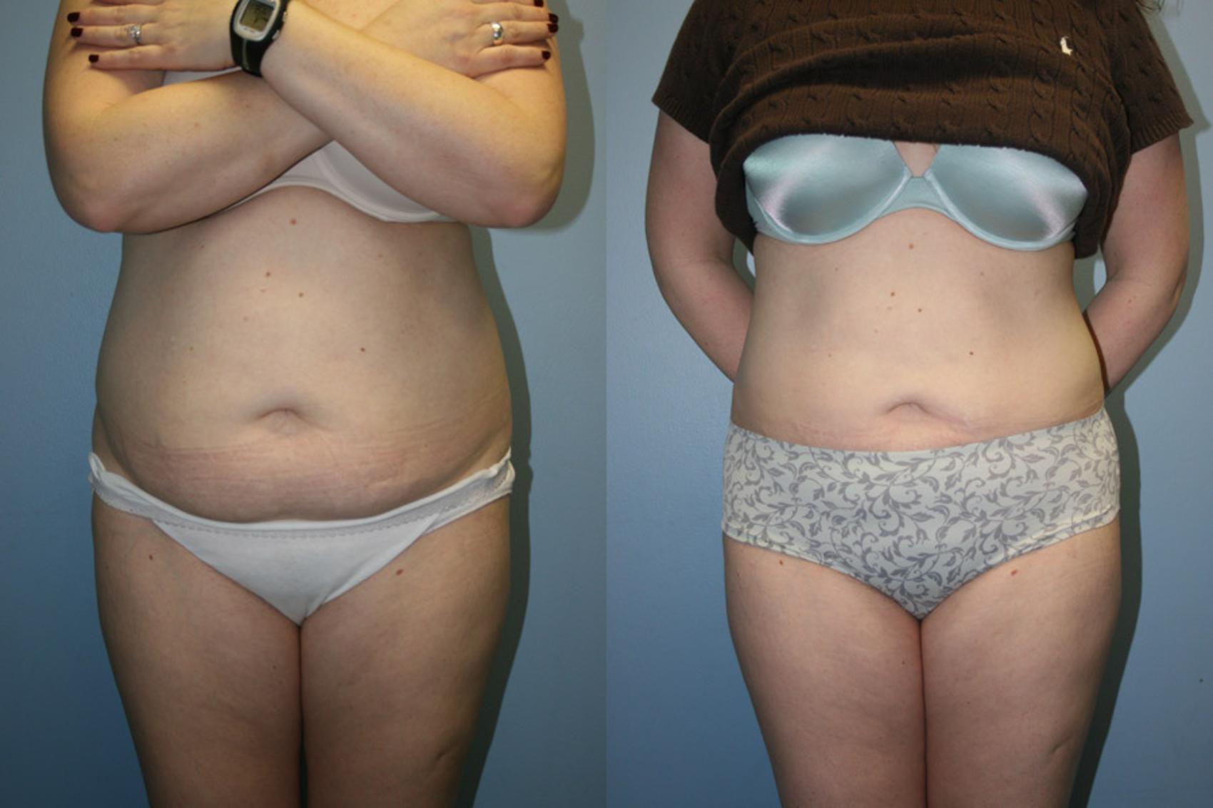 Tummy Tuck Before and After Photos Case 9