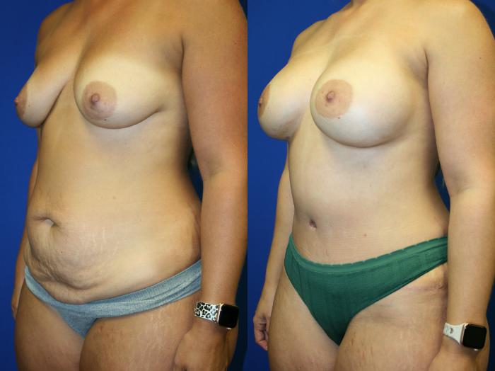 Mommy Makeover Case 105 Before & After Left Oblique | Downers Grove, IL | Dr. Sandeep Jejurikar