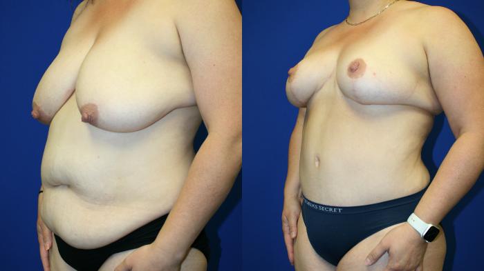 Mommy Makeover Case 136 Before & After Left Oblique | Downers Grove, IL | Dr. Sandeep Jejurikar