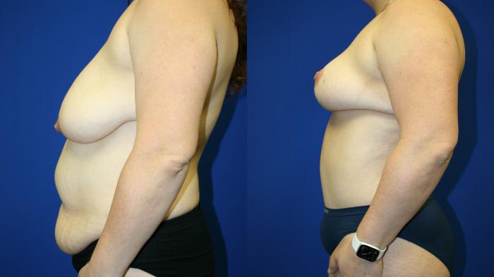 Mommy Makeover Case 136 Before & After Left Side | Downers Grove, IL | Dr. Sandeep Jejurikar