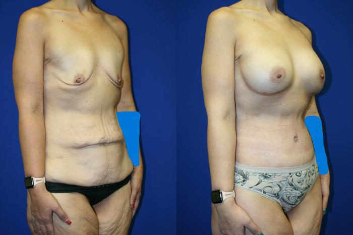 Mommy Makeover Case 73 Before & After Right Oblique | Downers Grove, IL | Dr. Sandeep Jejurikar