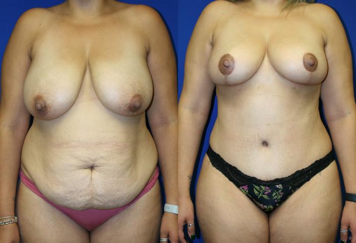 Breast Reduction Case 87 Before & After Front | Downers Grove, IL | Dr. Sandeep Jejurikar