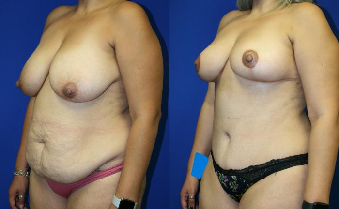 Breast Reduction Case 87 Before & After Left Oblique | Downers Grove, IL | Dr. Sandeep Jejurikar
