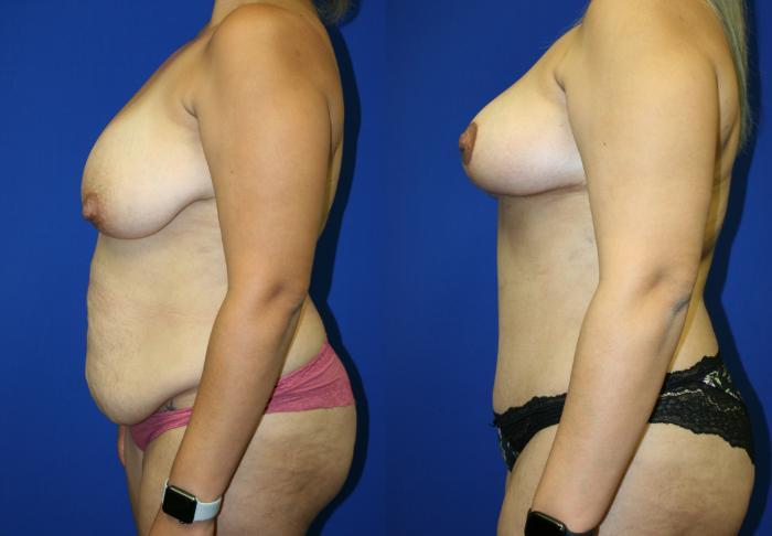 Liposuction Case 87 Before & After Left Side | Downers Grove, IL | Dr. Sandeep Jejurikar