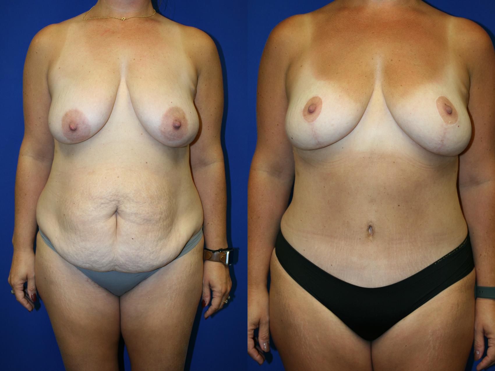 Breast Lift Case 93 Before & After Front | Downers Grove, IL | Dr. Sandeep Jejurikar