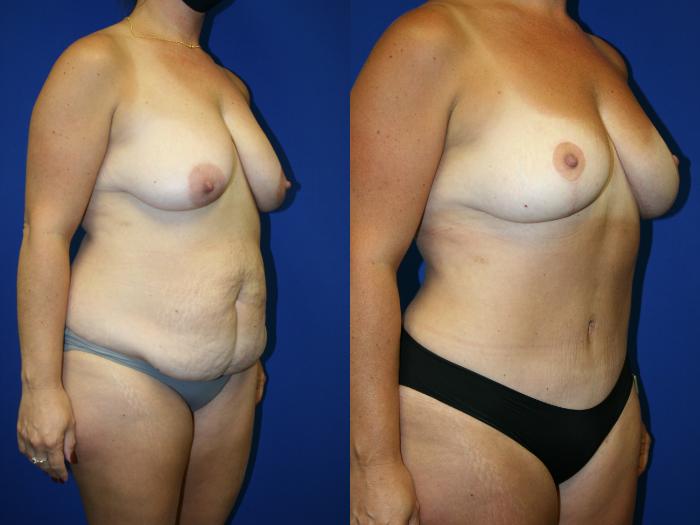 Liposuction Case 93 Before & After Right Oblique | Downers Grove, IL | Dr. Sandeep Jejurikar