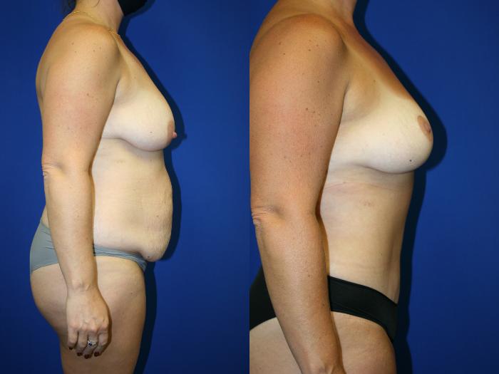 Breast Lift Case 93 Before & After Right Side | Downers Grove, IL | Dr. Sandeep Jejurikar
