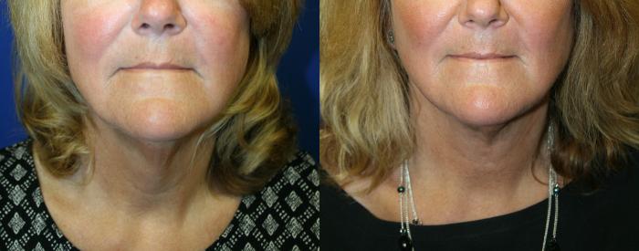 Neck lift Case 127 Before & After Front | Downers Grove, IL | Dr. Sandeep Jejurikar