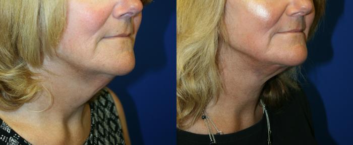 Neck lift Case 127 Before & After Right Oblique | Downers Grove, IL | Dr. Sandeep Jejurikar