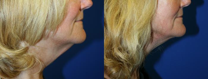 Neck lift Case 127 Before & After Right Side | Downers Grove, IL | Dr. Sandeep Jejurikar