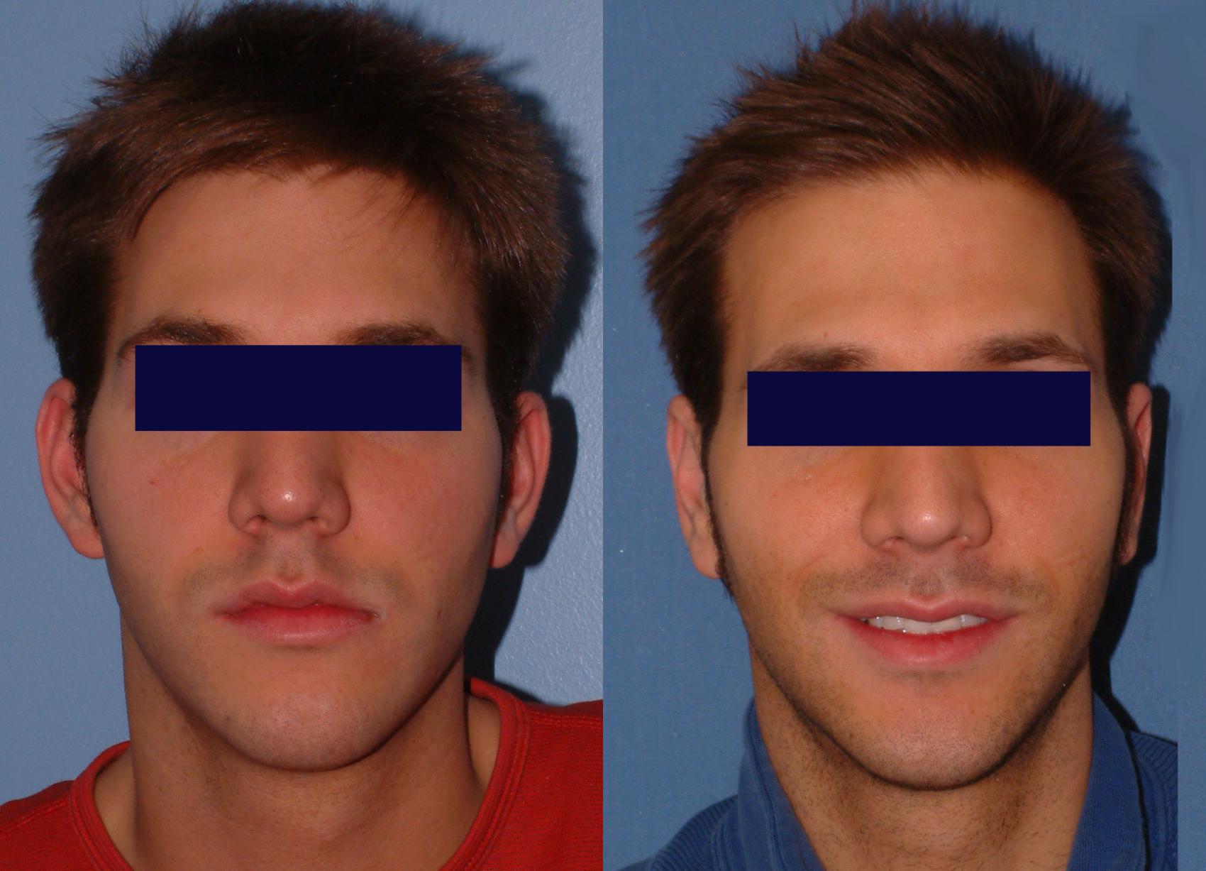 Otoplasty Case 27 Before & After View #1 | Downers Grove, IL | Dr. Sandeep Jejurikar