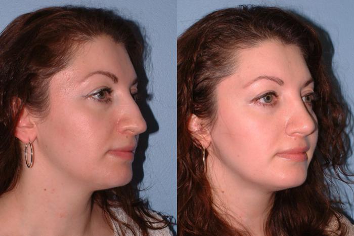 Rhinoplasty Case 11 Before & After View #2 | Downers Grove, IL | Dr. Sandeep Jejurikar