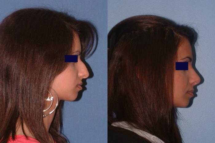 Rhinoplasty Case 15 Before & After View #1 | Downers Grove, IL | Dr. Sandeep Jejurikar