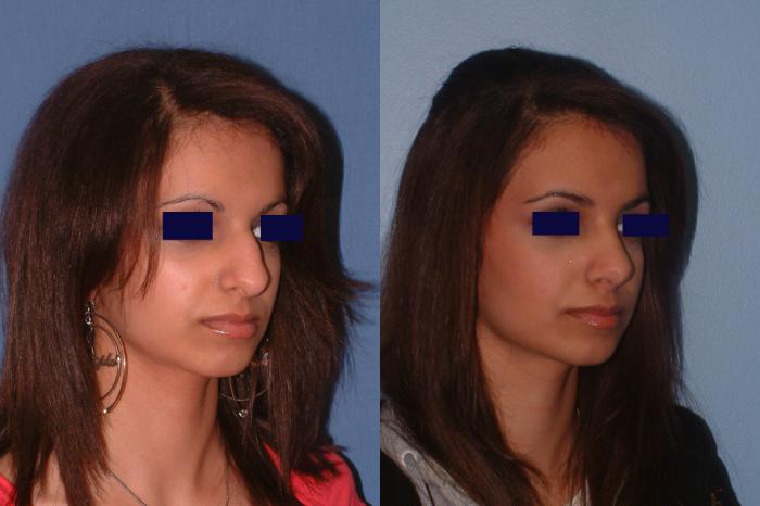 Rhinoplasty Case 15 Before & After View #2 | Downers Grove, IL | Dr. Sandeep Jejurikar