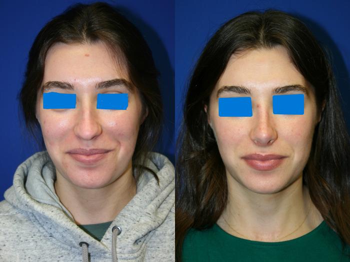 Rhinoplasty Case 78 Before & After Front | Downers Grove, IL | Dr. Sandeep Jejurikar