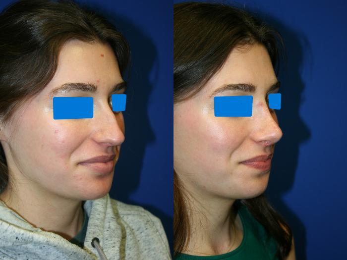 Rhinoplasty Case 78 Before & After Right Oblique | Downers Grove, IL | Dr. Sandeep Jejurikar
