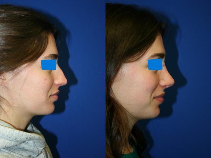 Rhinoplasty Case 78 Before & After Right Side | Downers Grove, IL | Dr. Sandeep Jejurikar