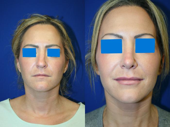 Rhinoplasty Case 96 Before & After Front | Downers Grove, IL | Dr. Sandeep Jejurikar