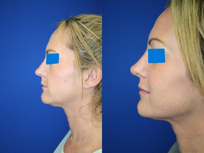 Rhinoplasty Case 96 Before & After Left Side | Downers Grove, IL | Dr. Sandeep Jejurikar