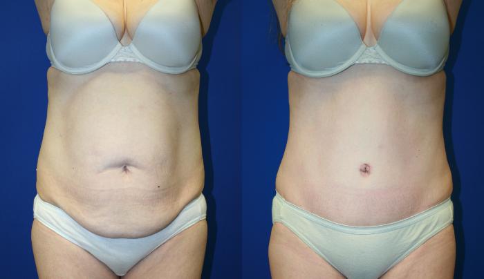 Tummy Tuck Case 107 Before & After Front | Downers Grove, IL | Dr. Sandeep Jejurikar