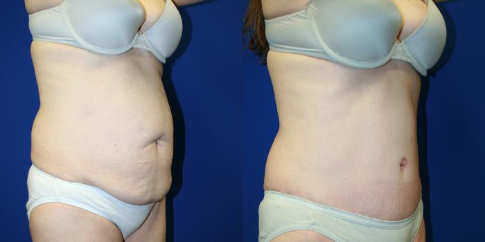 Tummy Tuck Case 107 Before & After Right Oblique | Downers Grove, IL | Dr. Sandeep Jejurikar