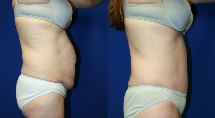 Tummy Tuck Case 107 Before & After Right Side | Downers Grove, IL | Dr. Sandeep Jejurikar