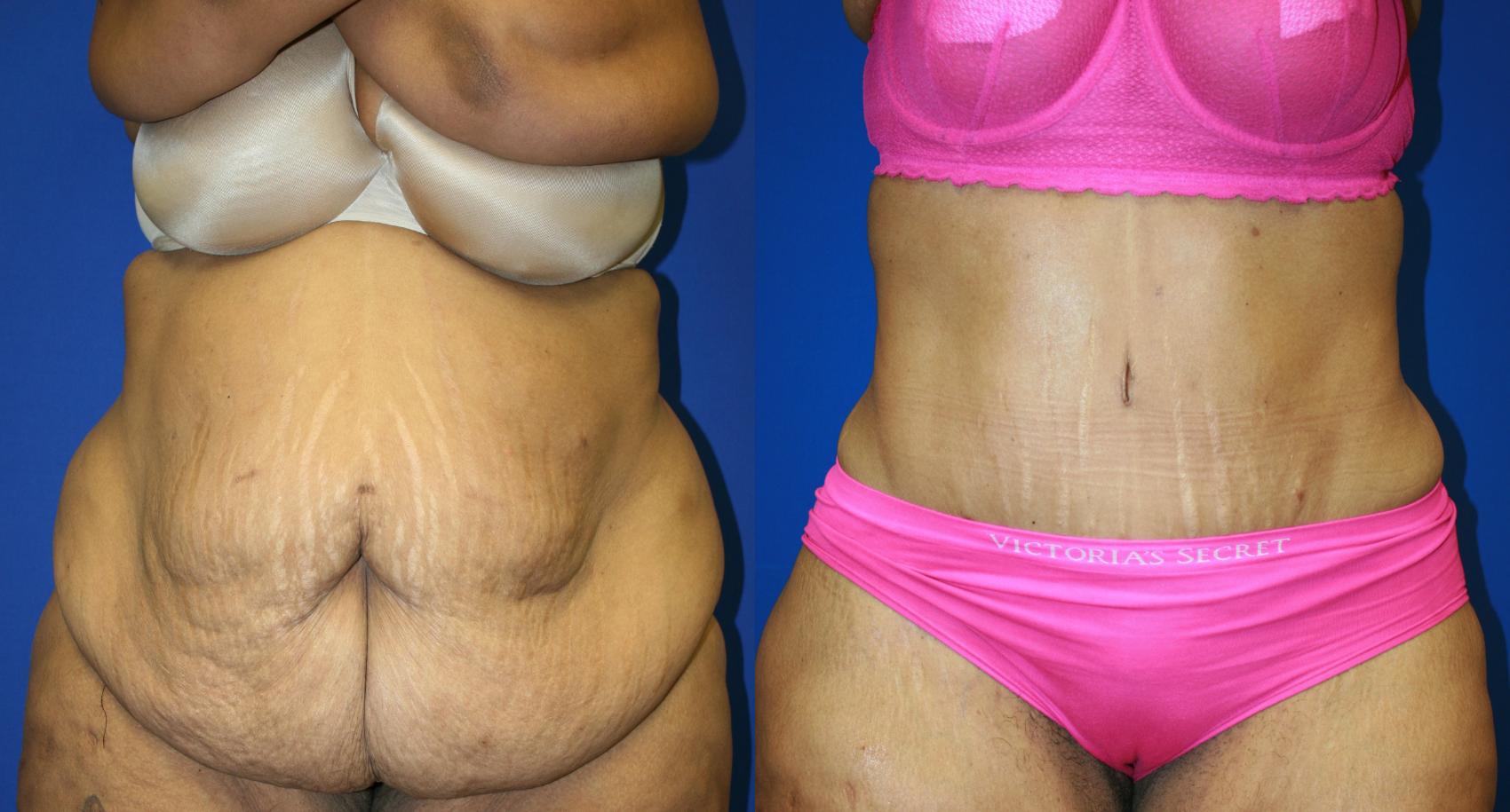 Tummy Tuck Case 109 Before & After Front | Downers Grove, IL | Dr. Sandeep Jejurikar