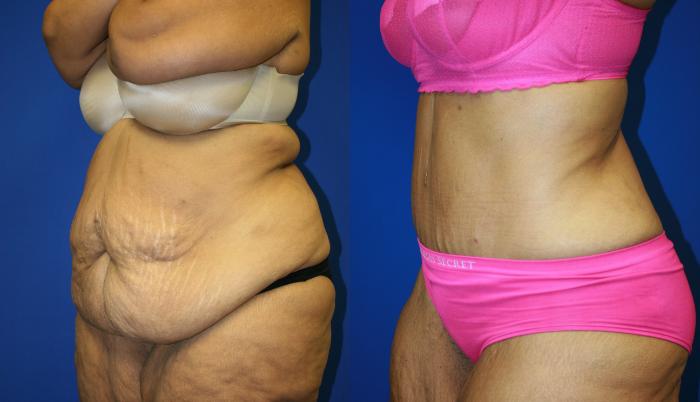 Tummy Tuck Case 109 Before & After Left Oblique | Downers Grove, IL | Dr. Sandeep Jejurikar