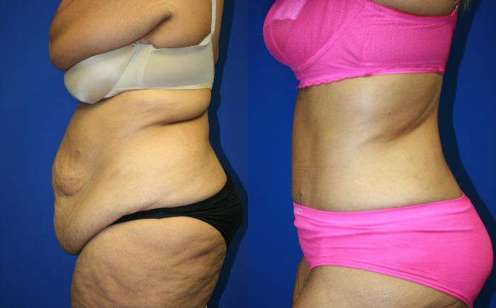 Tummy Tuck Case 109 Before & After Left Side | Downers Grove, IL | Dr. Sandeep Jejurikar