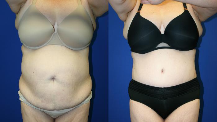 Tummy Tuck Case 113 Before & After Front | Downers Grove, IL | Dr. Sandeep Jejurikar