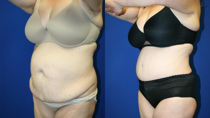 Tummy Tuck Case 113 Before & After Left Oblique | Downers Grove, IL | Dr. Sandeep Jejurikar