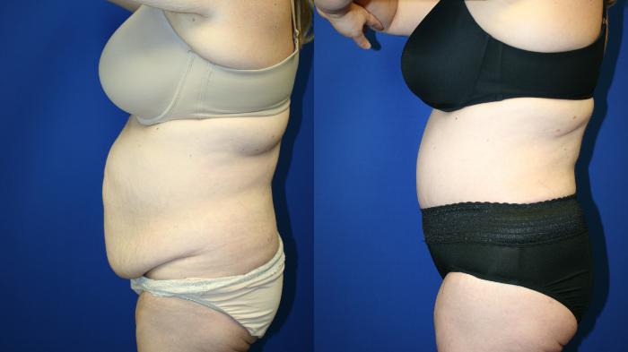 Tummy Tuck Case 113 Before & After Left Side | Downers Grove, IL | Dr. Sandeep Jejurikar