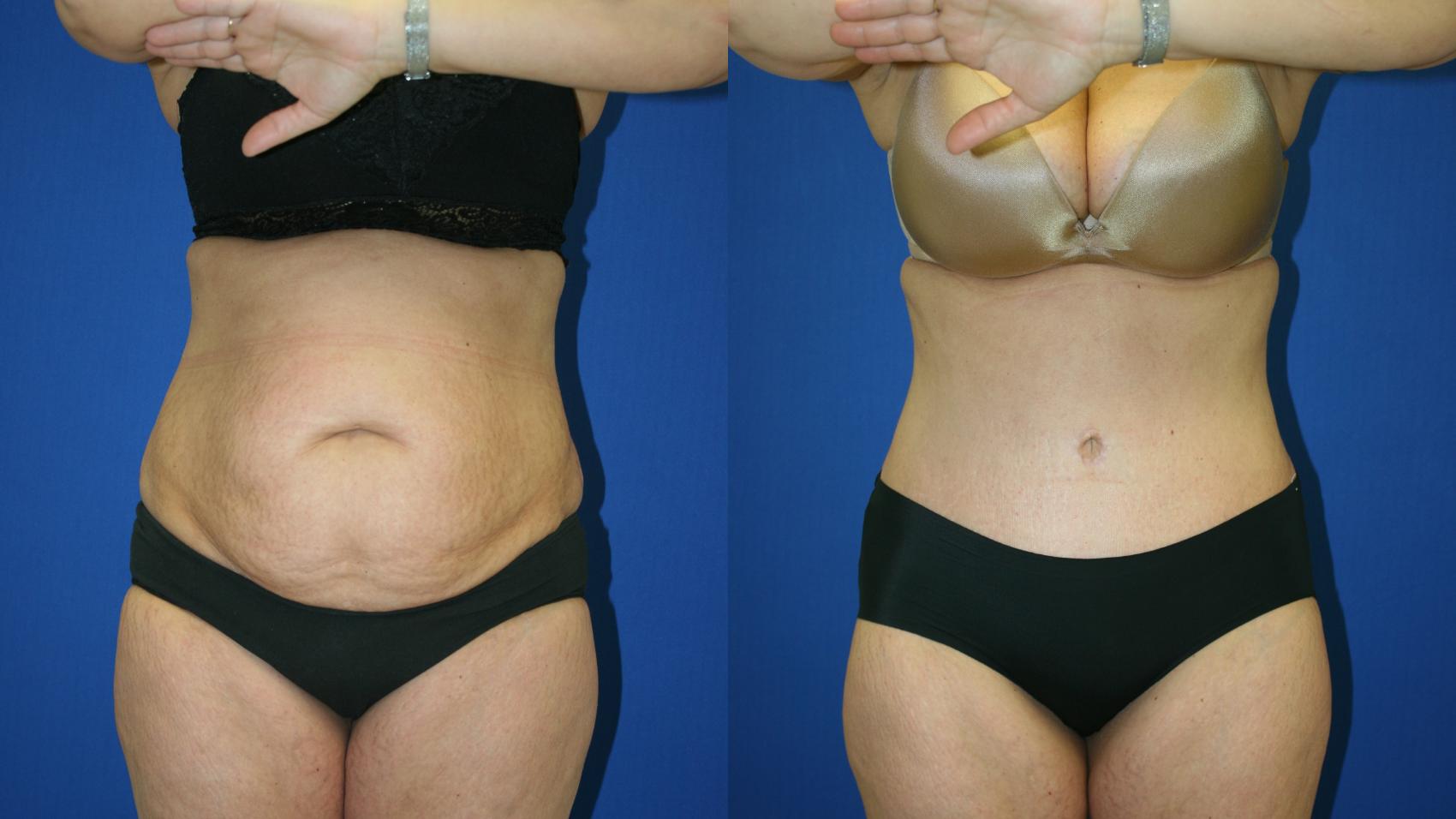 Tummy Tuck Case 115 Before & After Front | Downers Grove, IL | Dr. Sandeep Jejurikar