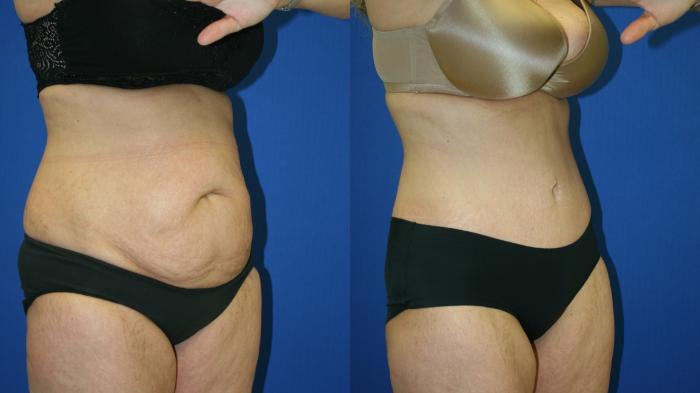 Tummy Tuck Case 115 Before & After Right Oblique | Downers Grove, IL | Dr. Sandeep Jejurikar