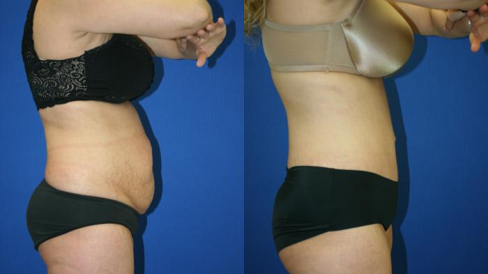 Tummy Tuck Case 115 Before & After Right Side | Downers Grove, IL | Dr. Sandeep Jejurikar