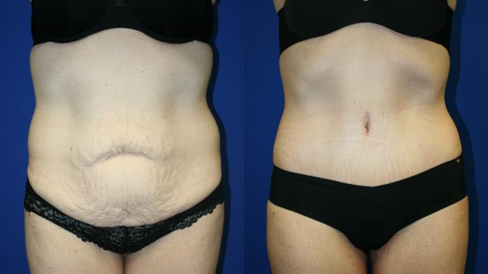 Tummy Tuck Case 119 Before & After Front | Downers Grove, IL | Dr. Sandeep Jejurikar