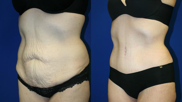 Tummy Tuck Case 119 Before & After Left Oblique | Downers Grove, IL | Dr. Sandeep Jejurikar