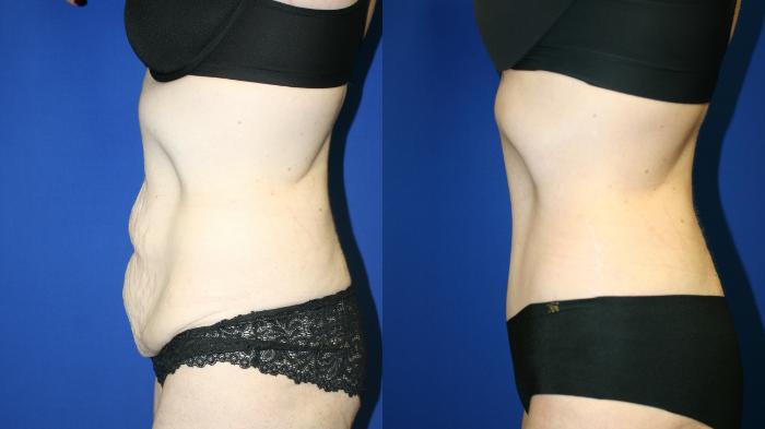 Tummy Tuck Case 119 Before & After Left Side | Downers Grove, IL | Dr. Sandeep Jejurikar